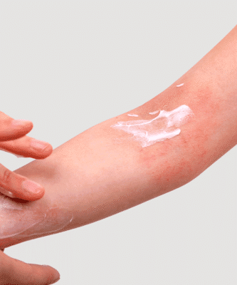 Atopijska koža i atopijski dermatitis
